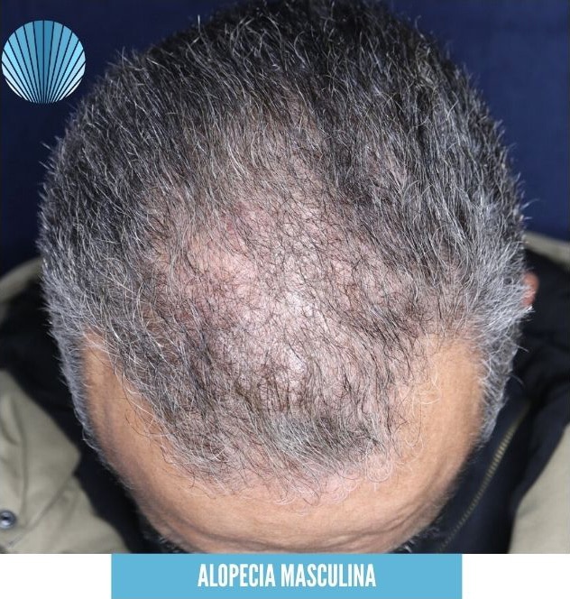Alopecia masculina-Tricologo Alicante-Derclinic