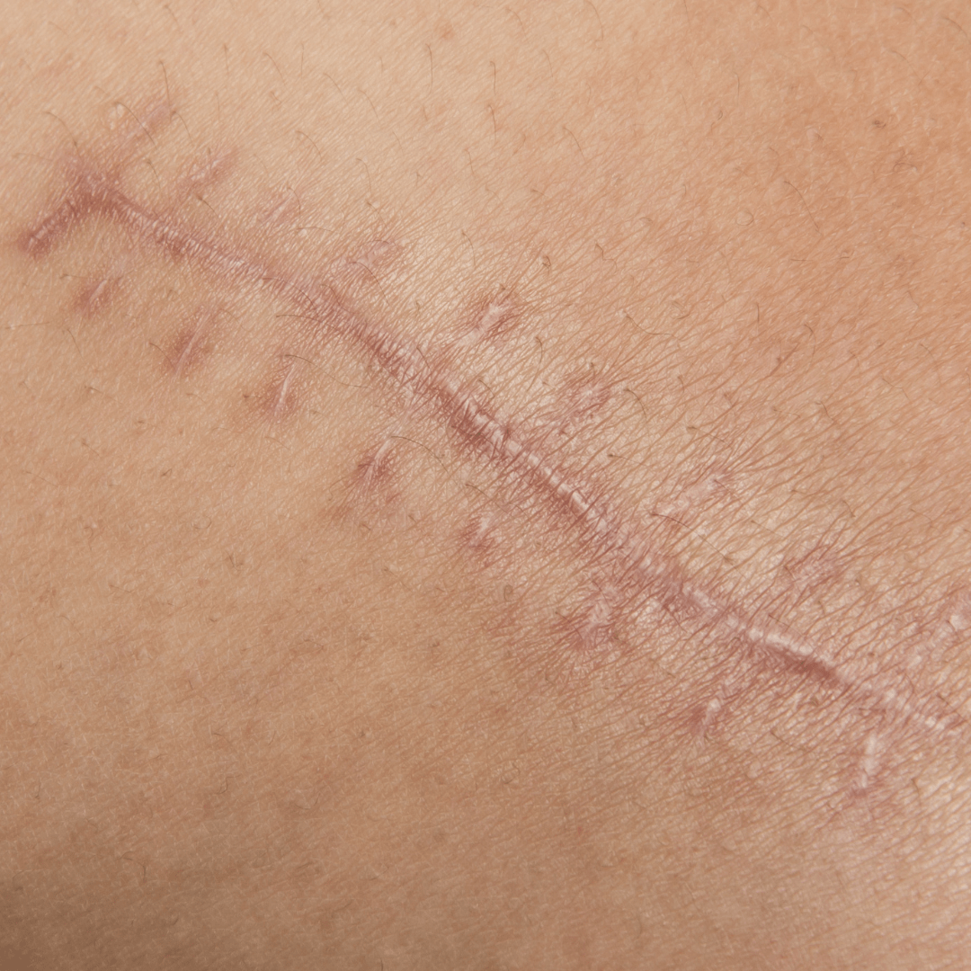 Cicatrices Quirúrgicas - Cicatrización Asistida por Láser