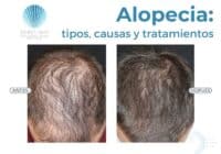 Alopecia-tricologos alicante